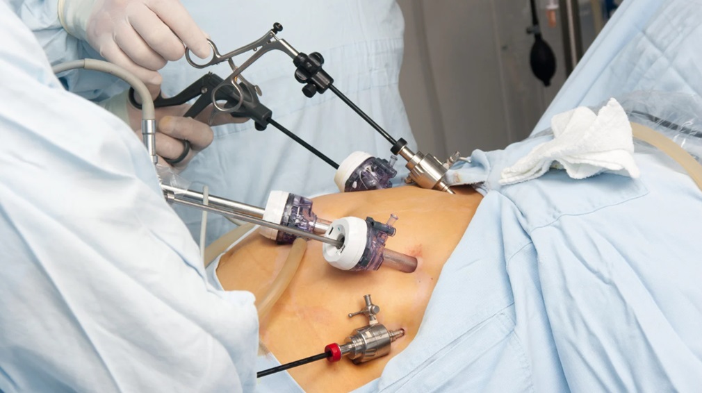 Gastric Sleeve Journey